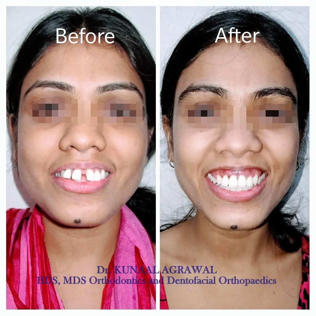 braces before and after bhopal 5
